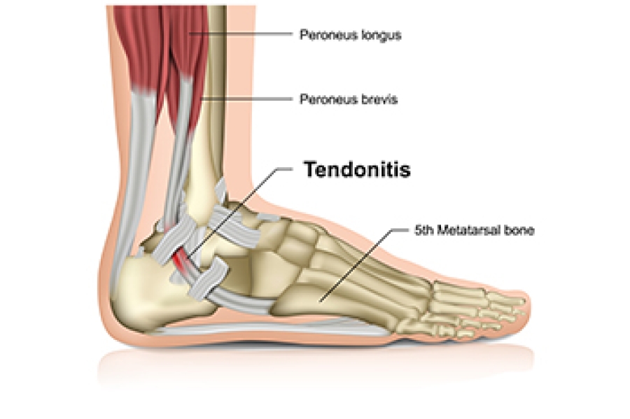 Common Achilles Tendon Injuries and How to Find Relief